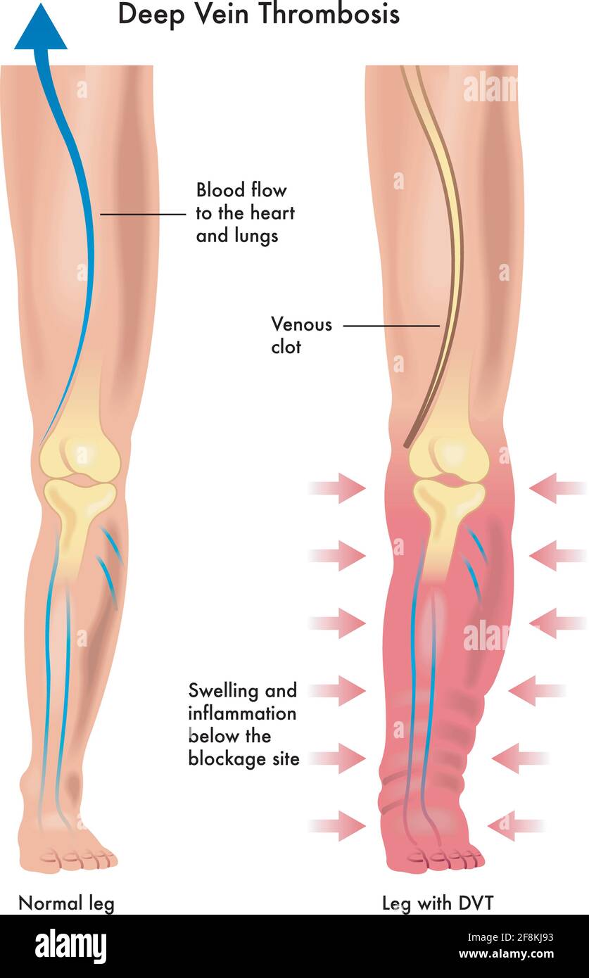 La trombosis venosa profunda fotografías e imágenes de alta resolución -  Alamy