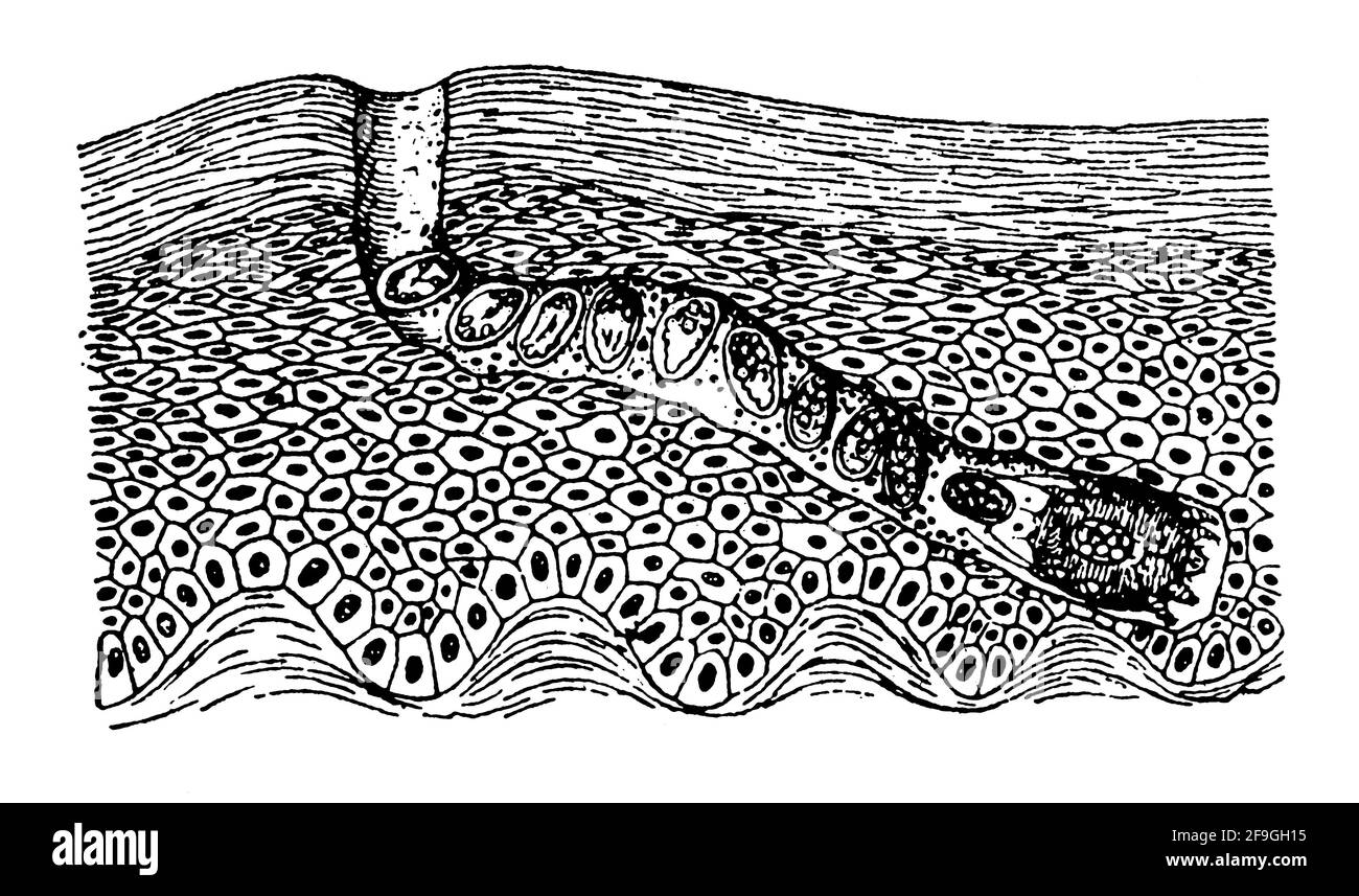 Sección transversal esquemática a través de un conducto de ácaros en la epidermis. Ilustración del siglo 19th. Alemania. Fondo blanco. Foto de stock