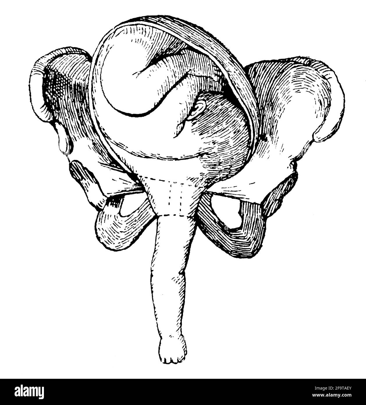 Patología durante el parto. Presentación del hombro. Ilustración del siglo 19th. Alemania. Fondo blanco. Foto de stock