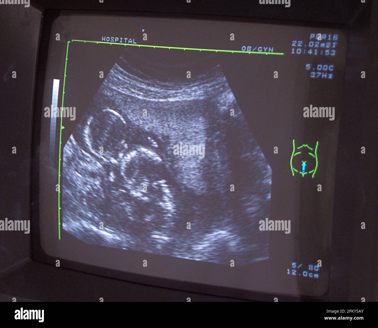 imagen de pantalla de ultrasonido de bebés gemelos con mortinatos  intrauterinos Fotografía de stock - Alamy