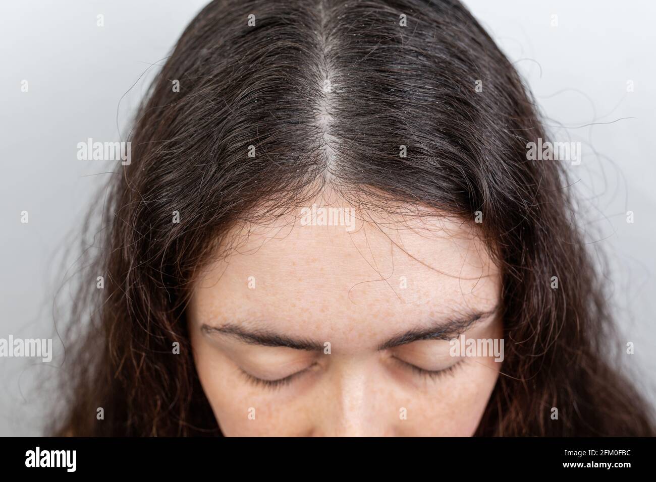 Primer plano de una mujer que muestra un cuero cabelludo sobre un fondo  blanco. Cabello oscuro con caspa Fotografía de stock - Alamy