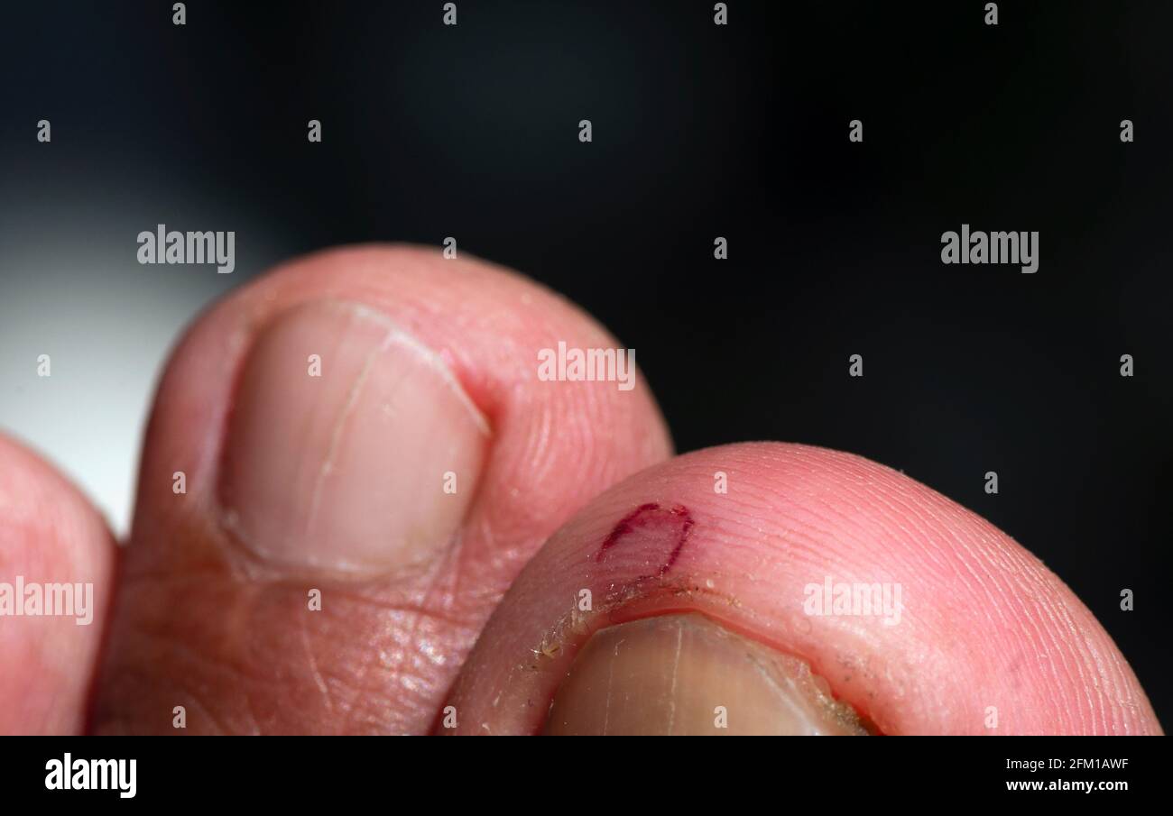 Lesión en el dedo gordo del pie fotografías e imágenes de alta resolución -  Alamy