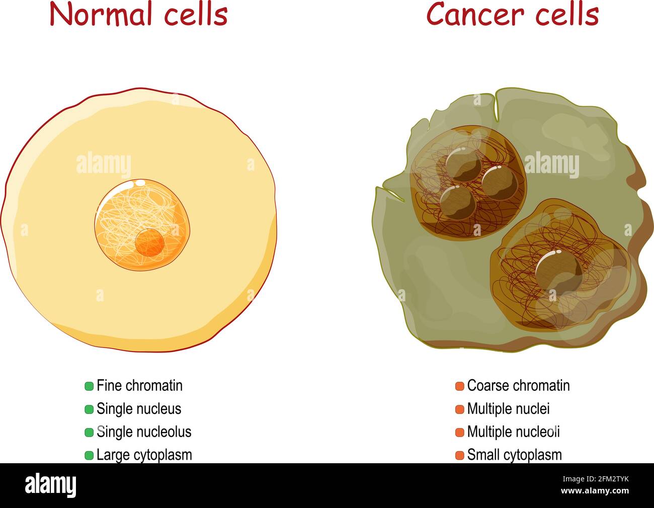 Cáncer y células normales. Comparación y diferencia entre tejido sano y tumor. Detalles sobre la cromatina, el núcleo y el citoplasma. Vector Ilustración del Vector