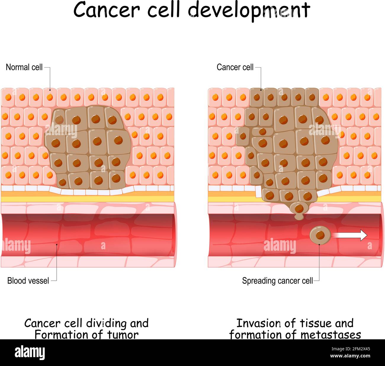 Desarrollo de cáncer de células normales a la formación de tumor, diseminación de células cancerosas en el flujo sanguíneo, invasión de otros tejidos y formación de metástasis Ilustración del Vector