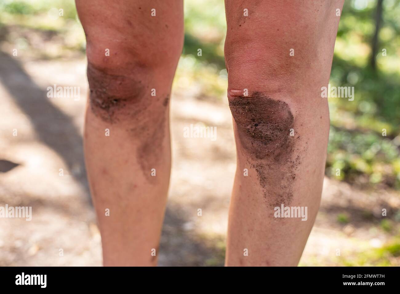 Las rodillas sucias en una mujer adulta, cerca, en el campamento, sobre un fondo borroso. Foto de stock