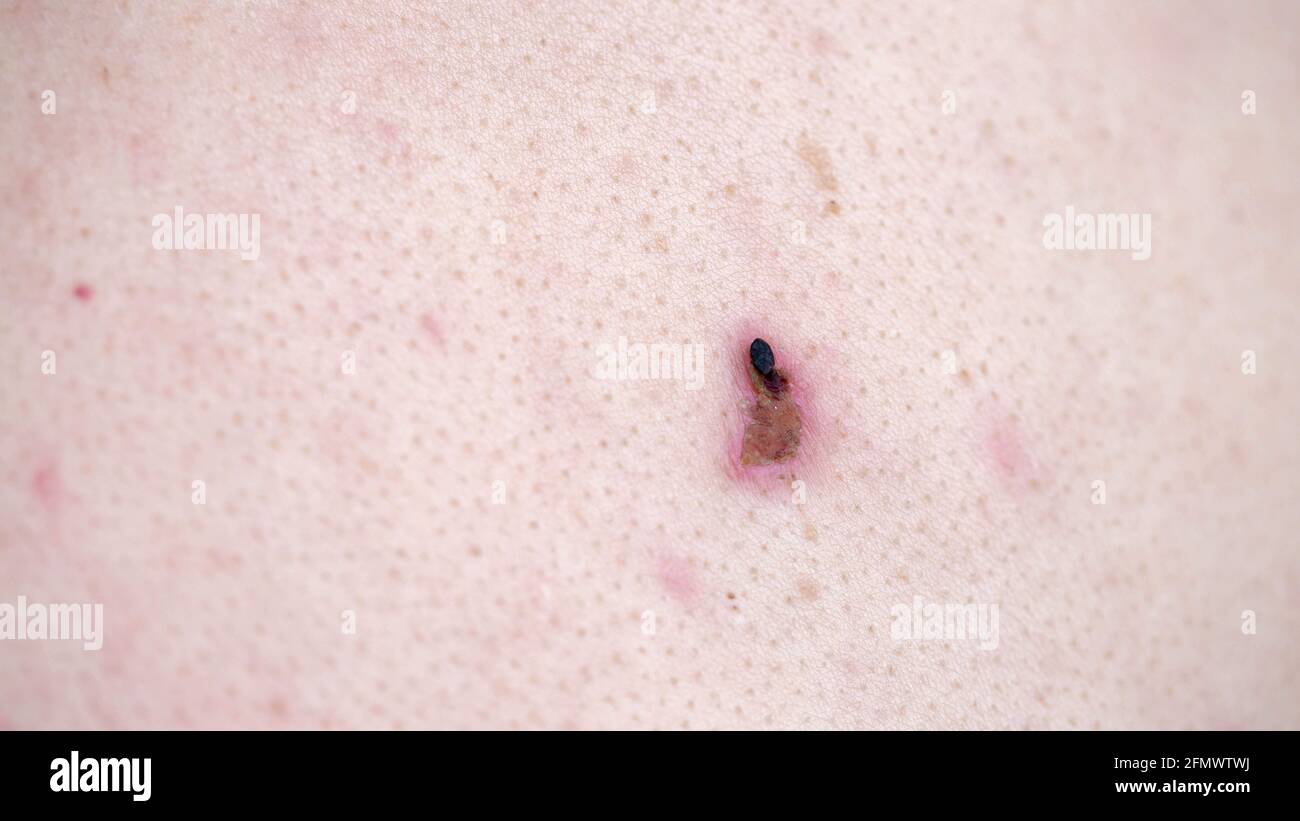 sugerir tempo Acelerar eliminación del papiloma en la piel humana, cauterización de las verrugas con un láser. Espacio de copia para texto Fotografía de stock - Alamy sugerir tempo Acelerar eliminación del papiloma en la piel humana, cauterización de las verrugas con un láser. Espacio de copia para texto Fotografía de stock - Alamy