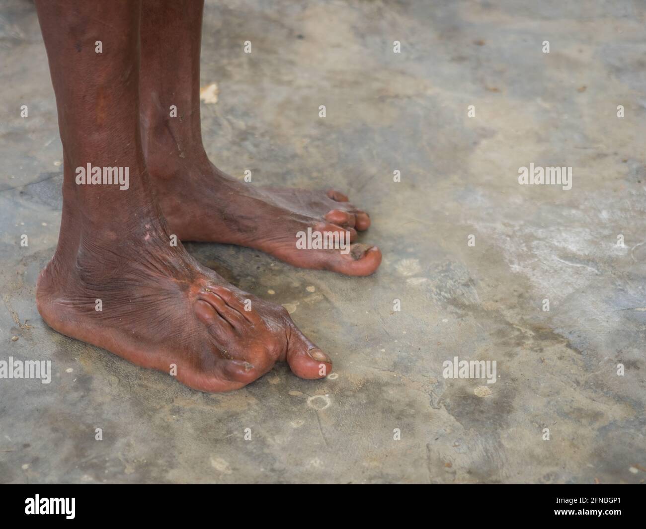 Una persona con deformidades en las piernas debido a la polio u otras enfermedades en el medio de la península de Bird's Head en la selva Indonesia, Papúa Occidental, Indonesia, Asia Foto de stock