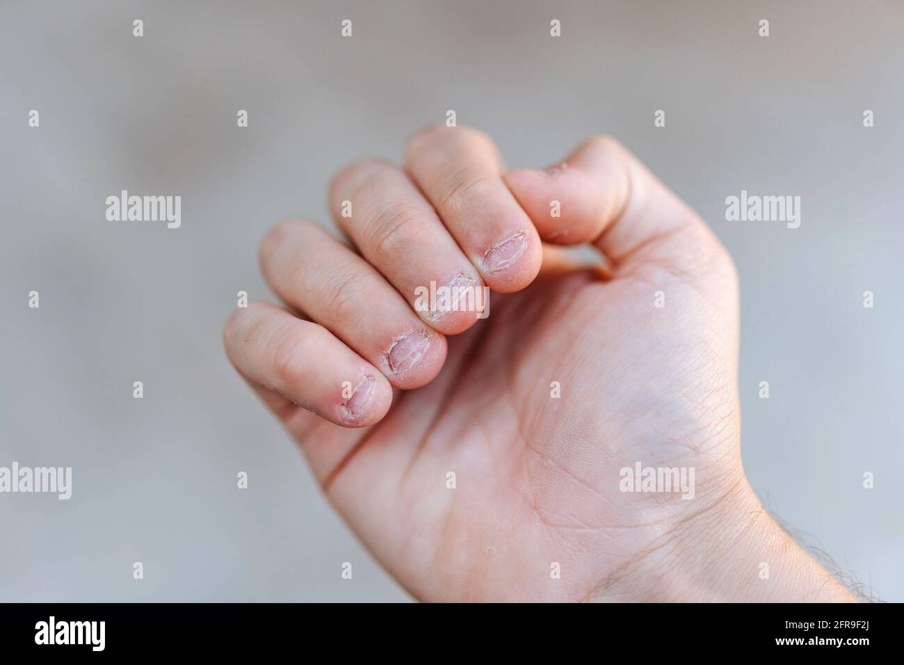La mano de un hombre con uñas picadas y feas. Mal cuidado de las manos  Fotografía de stock - Alamy