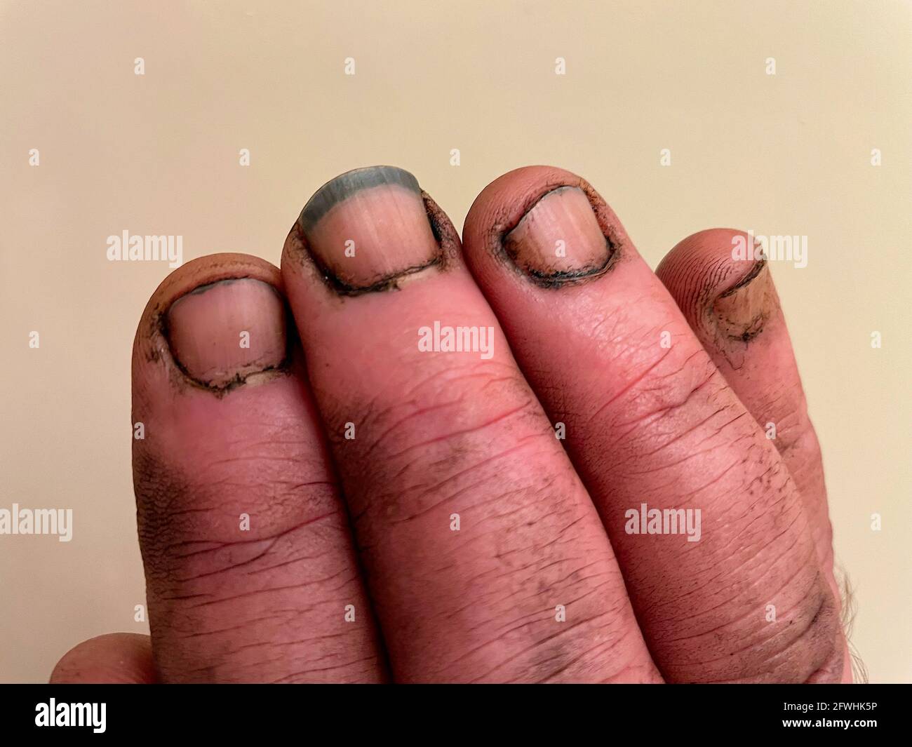 https://c8.alamy.com/compes/2fwhk5p/primer-plano-de-los-dedos-sucios-de-un-hombre-despues-de-trabajar-en-un-equipo-sucio-con-suciedad-debajo-de-las-unas-2fwhk5p.jpg