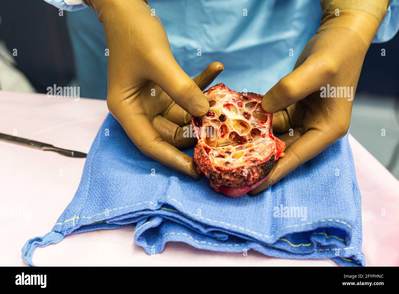 Examen de un tumor quístico del riñón después de la resección, Francia. Foto de stock