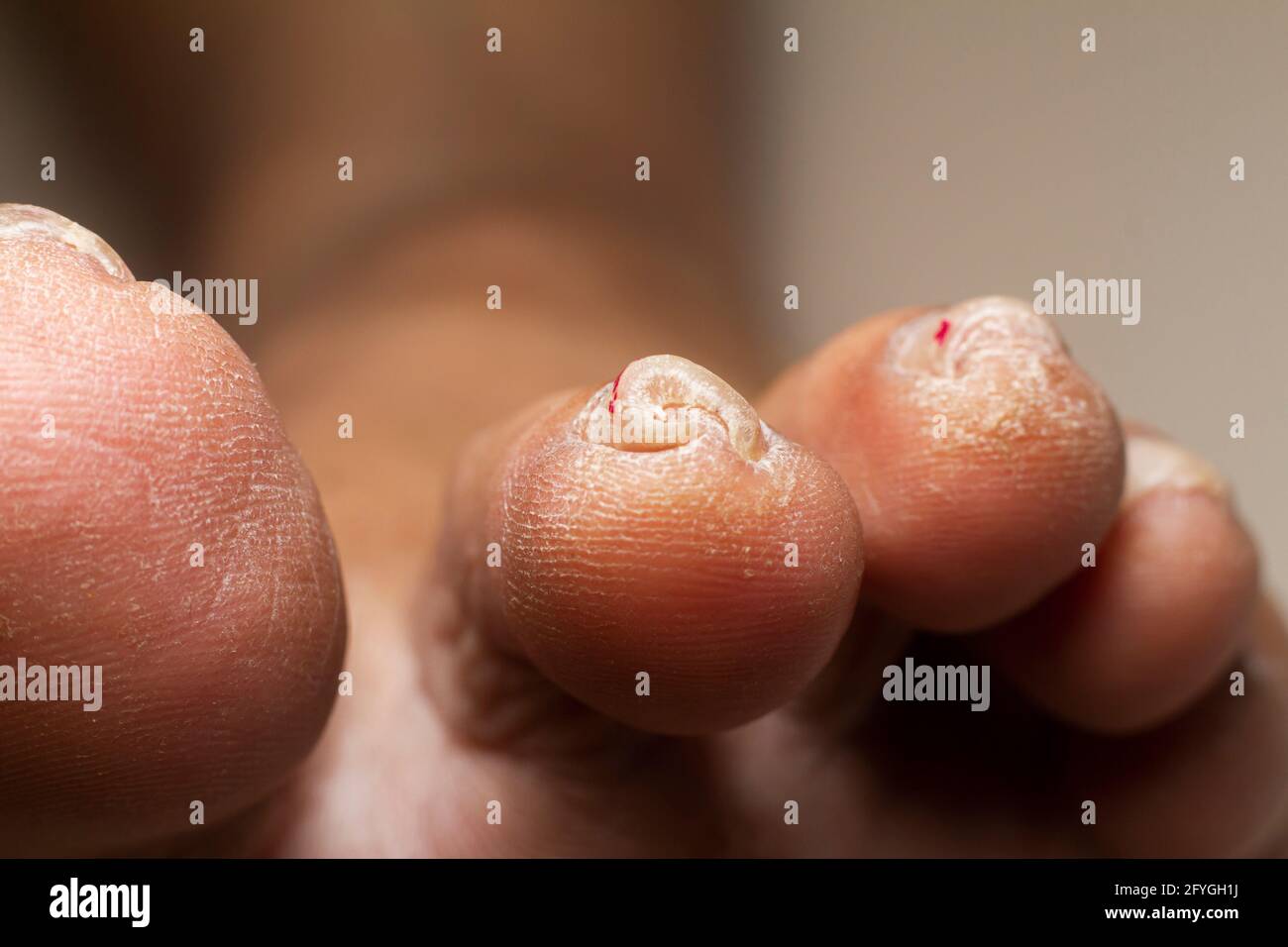 primer plano de la foto de stock de uñas de los pies. Foto de stock