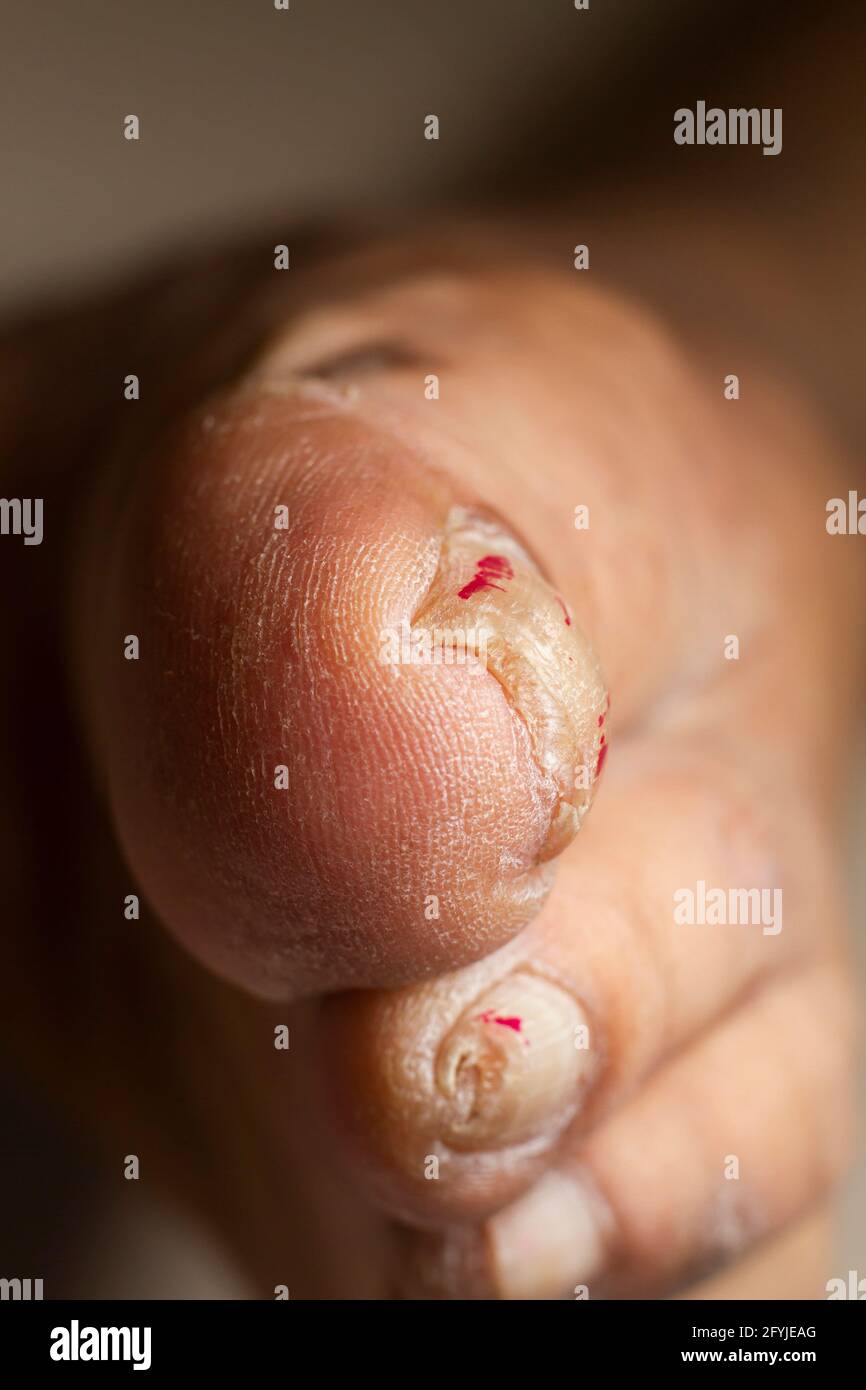 primer plano de la foto de stock de uñas del pulgar del pie Foto de stock