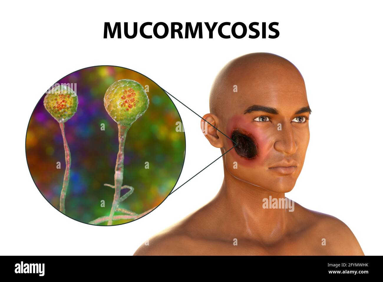 Mucormicosis Cutánea Ilustración Fotografía De Stock Alamy 9121