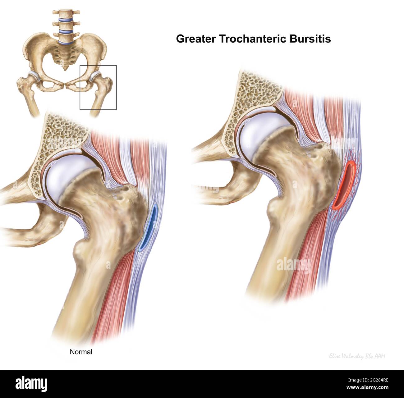 Detalle que muestra una mayor bursitis del trochanter en la articulación de la cadera. Foto de stock