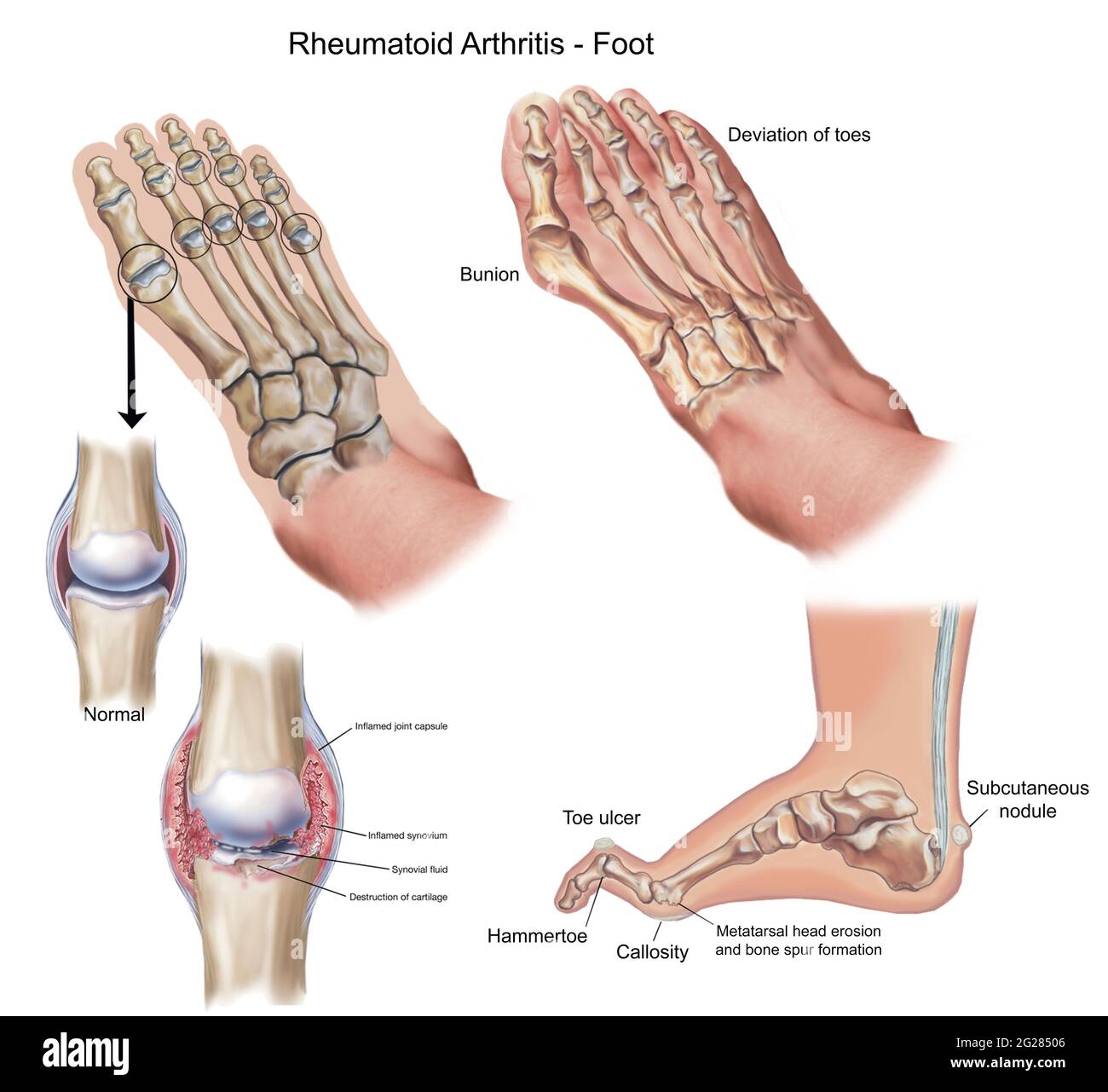 Vista superior y lateral del pie que muestra deformidades causadas por la artritis reumatoide. Foto de stock