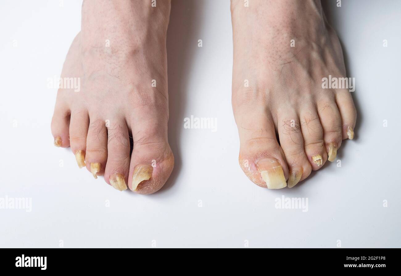 Pies del hombre con uñas largas infectadas por Fungus Foto de stock