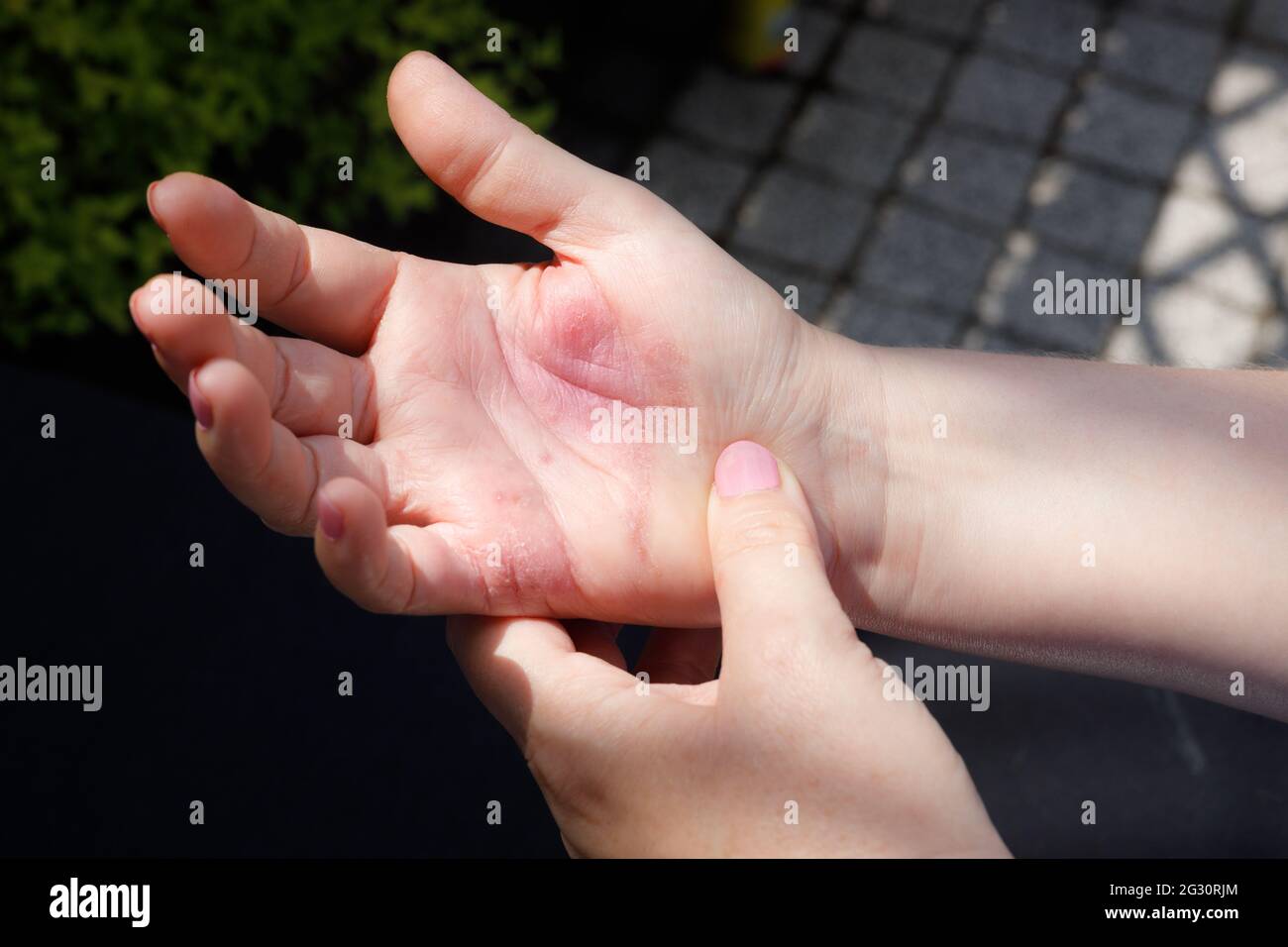 Mujer rascando mano picor, concepto, dermatitis atópica, manos rojas,  problema dermatológico Fotografía de stock - Alamy