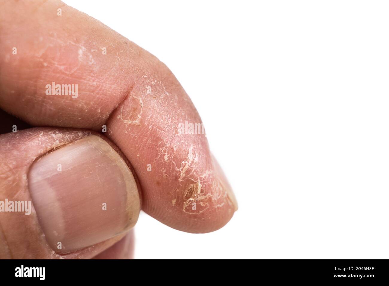 Primer plano de la piel seca dolorosa e inflamada en el dedo Fotografía de  stock - Alamy