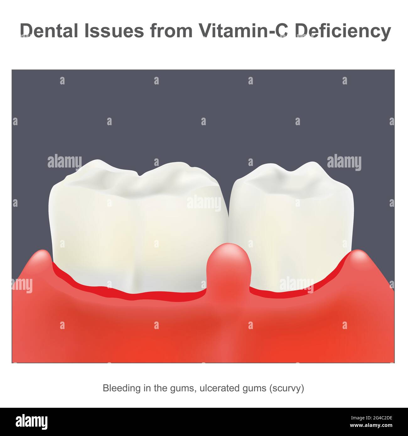 Problemas dentales por deficiencia de vitamina C. Ilustración sobre una vitamina C esencial para la salud dental en la enfermedad protectora escorbuto. Ilustración del Vector