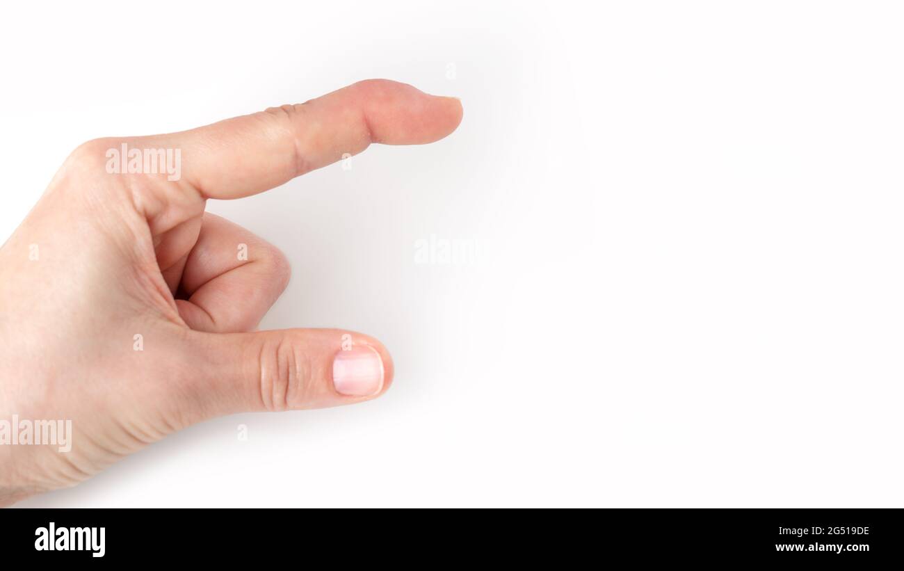 parte de la mano izquierda que muestra tamaño, tamaño, longitud con dedo  índice y pulgar, dedo índice con una lesión del tendón extensor, dedo  martillo, punta flexionada hacia abajo, deformidad en el