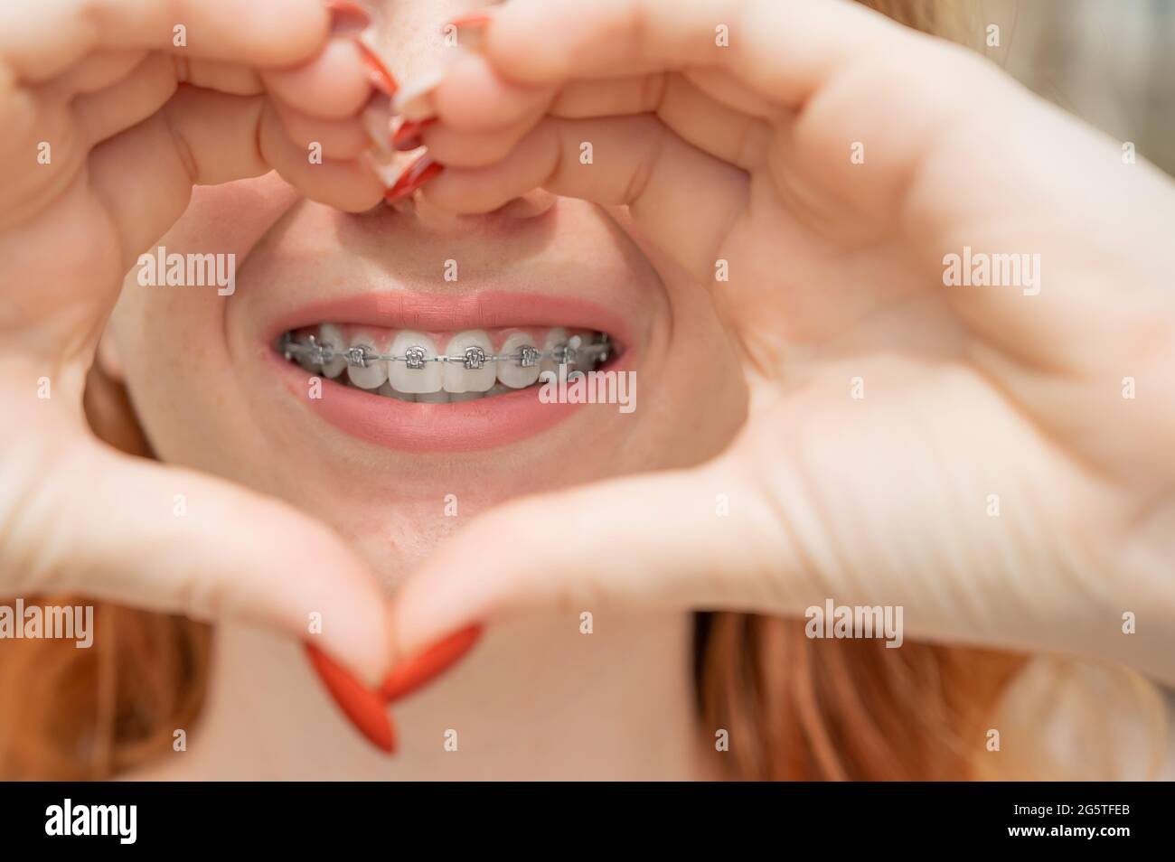 Retrato de cerca de una joven mujer de pelo rojo con llaves en sus dientes sosteniendo sus manos en forma de corazón. Aparatos de ortodoncia para un perfecto Foto de stock