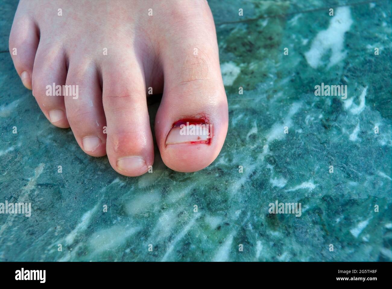 Dedo gordo del pie con placa de clavos de sangrado dañada Fotografía de  stock - Alamy
