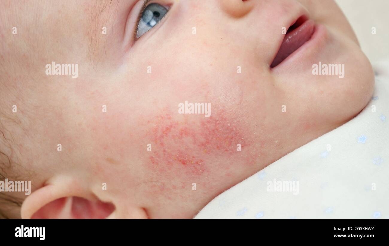 Cuidados de la piel del recién nacido - Clínica Pintado