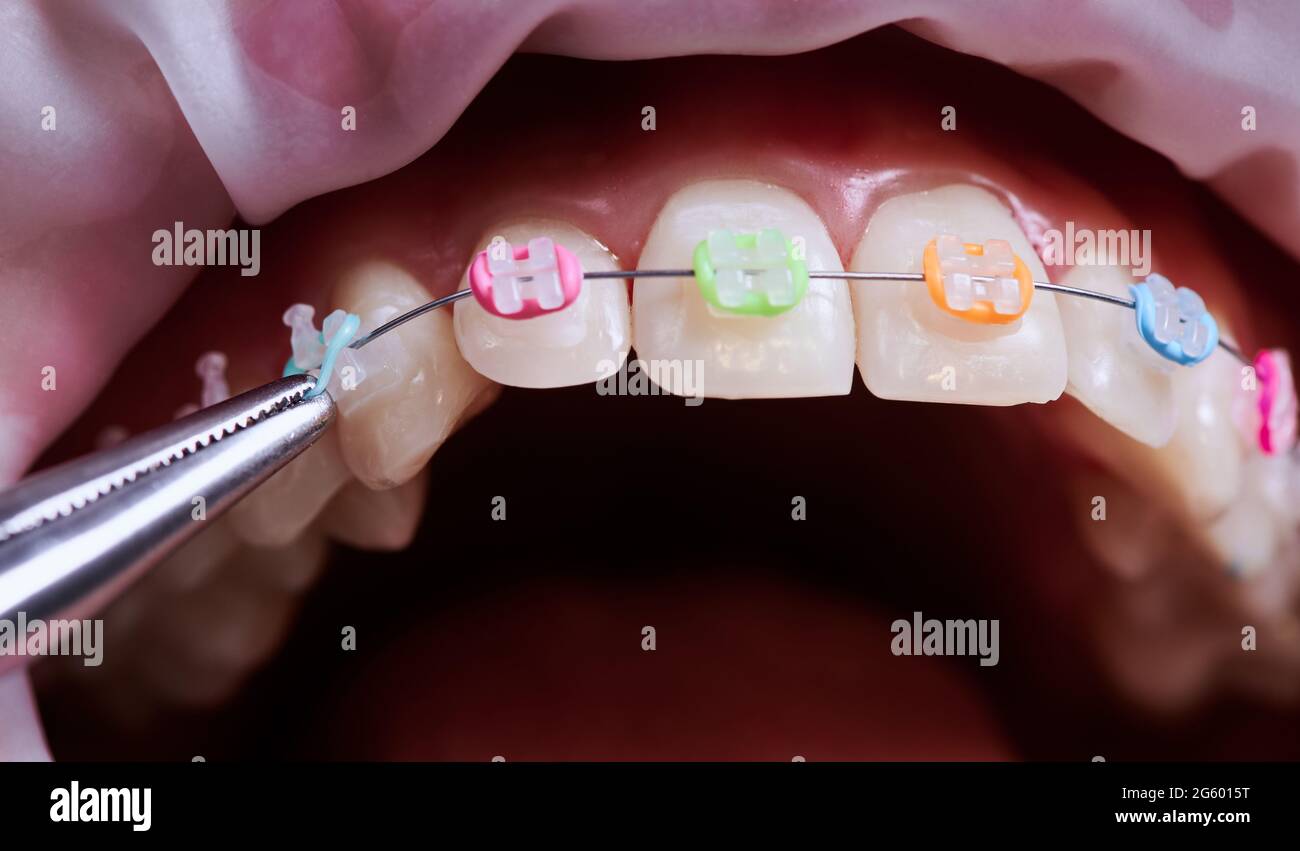 Primer plano del médico que fija coloridas bandas elásticas de goma a los  soportes del paciente. Persona con aparatos de ortodoncia en los dientes  que se realiza un procedimiento dental en la