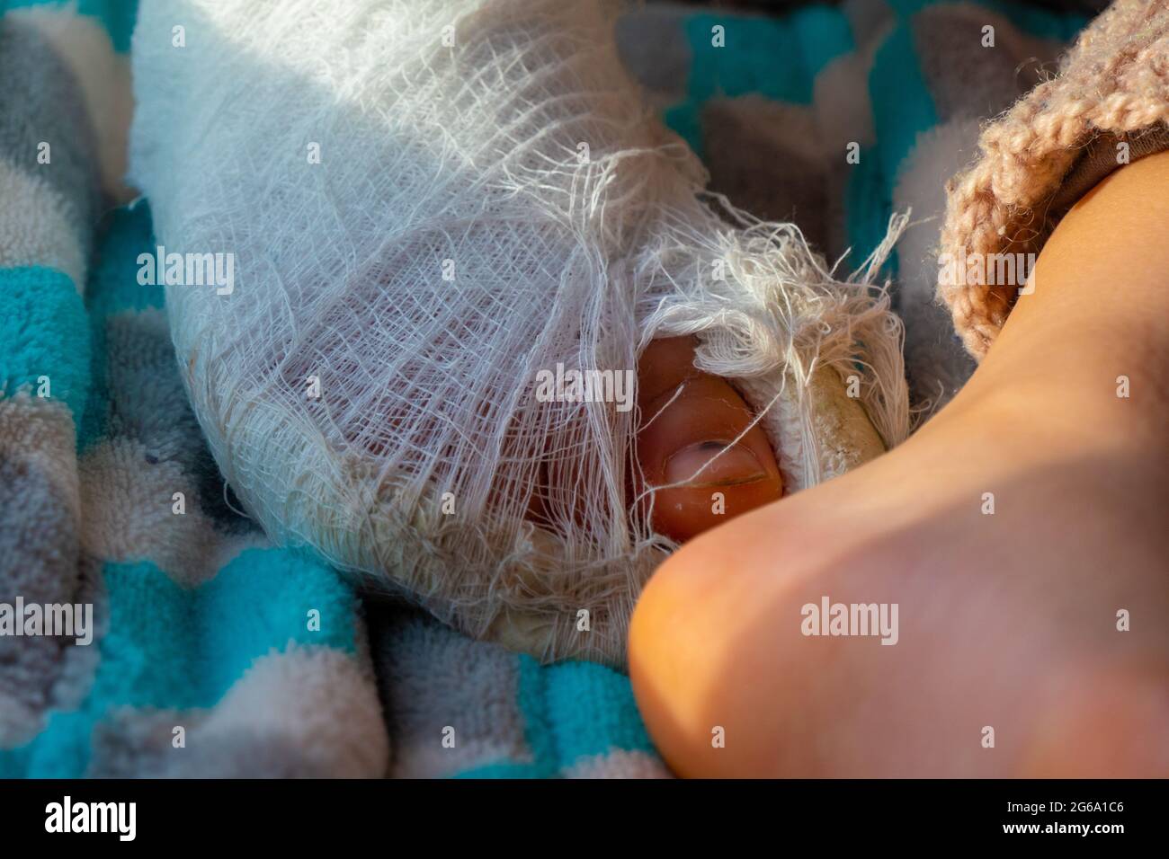 Niño con venda en la fractura del talón de la pierna. Pie derecho roto, hueso, pantorrilla, tobillo, pierna en yeso, férula de niño. Pequeño boi durmiendo en una blanke azul Foto de stock