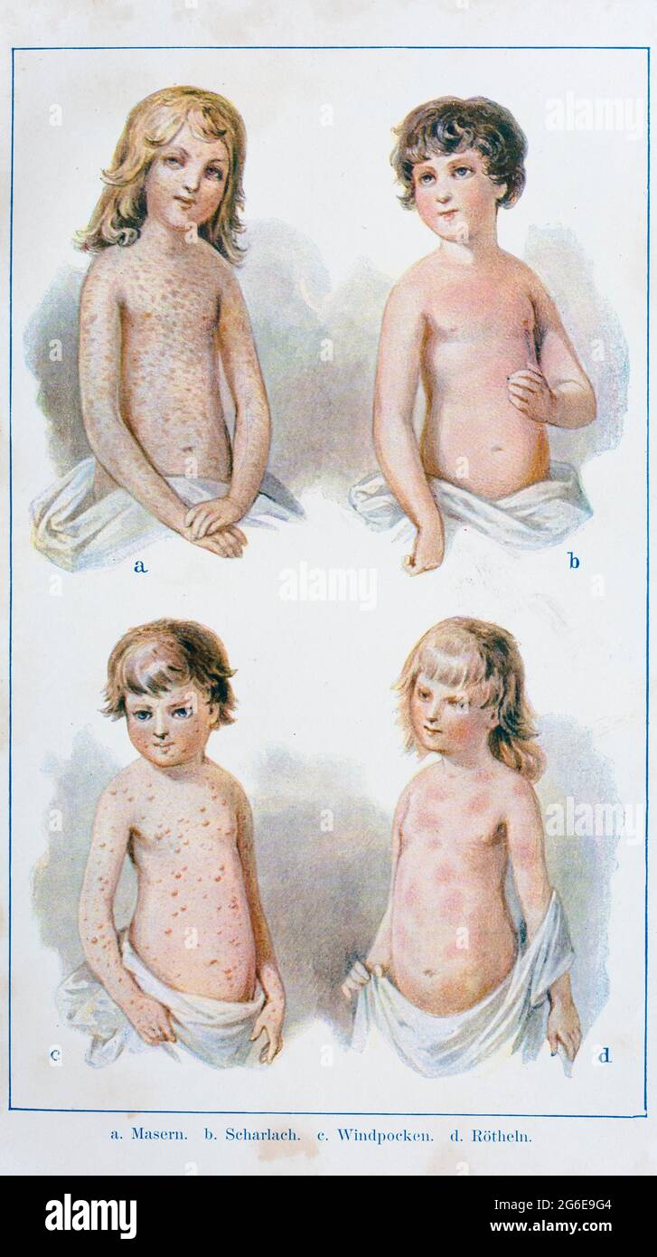 Las cuatro enfermedades infantiles, sarampión, escarlatina, varicela, rubéola, Der praktische Hausarzt, Ein Weg zur Gesundheit, 1901, Breslau Foto de stock