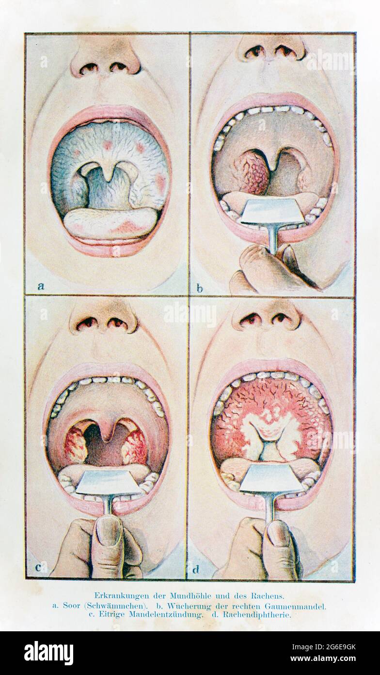 Enfermedades de la cavidad oral, amigdalitis, proliferación, der praktische Hausarzt, Ein Weg zur Gesundheit, 1901, Breslau Foto de stock
