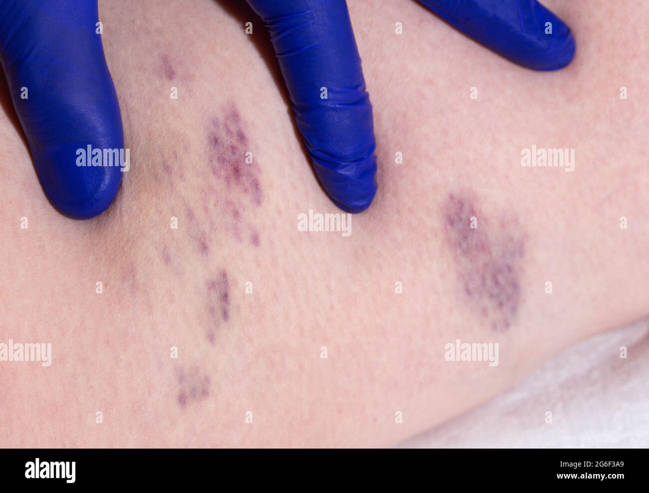 Moretones y trombosis en las piernas de una mujer. Phlebeurysm, primer  plano Fotografía de stock - Alamy