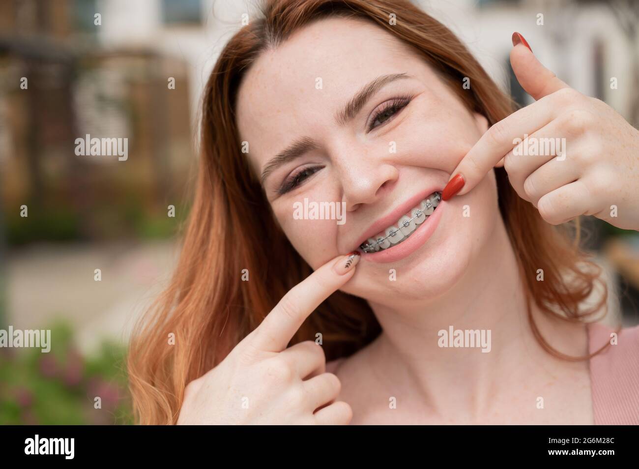 Cheerful Orthodontic Braces Beauty Dental Health Happiness Fotos E Imagenes De Stock Alamy