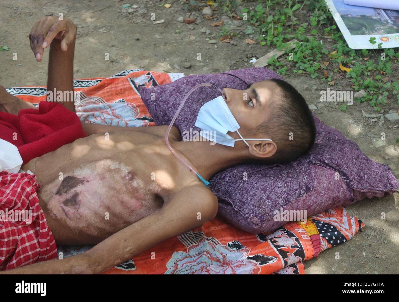 Julio de 14,2021. Dhaka, Bangladesh: Saiful Islam, edad 14 años. Fue admitido en la unidad de quemaduras del Hospital Médico de Dhaka durante tres meses y veinte días Foto de stock