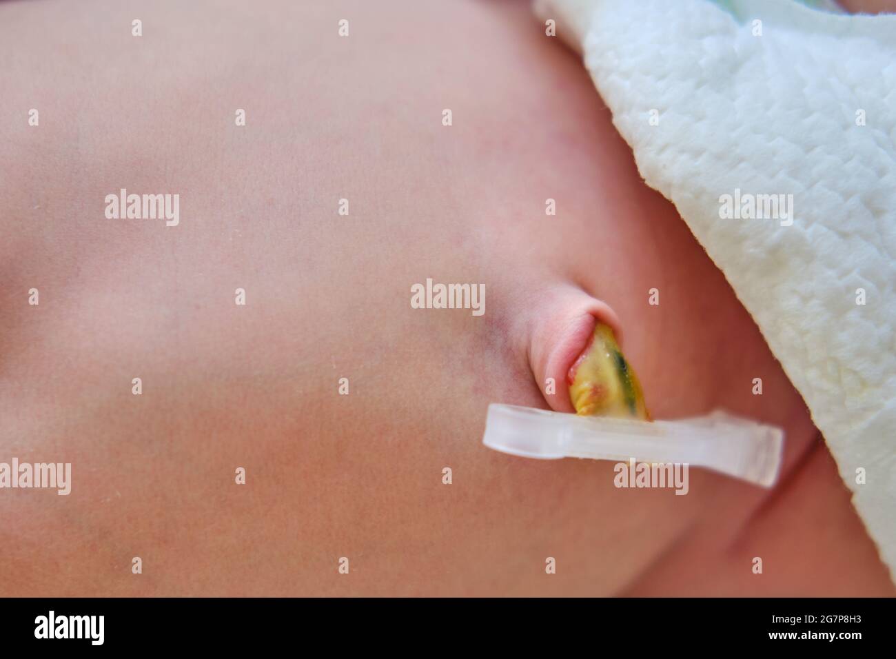 El Cordon Umbilical De Un Bebe Recien Nacido Con Un Clothespin En La Barriguita Fotografia De Stock Alamy El Cordon Umbilical De Un Bebe Recien Nacido Con Un Clothespin En La Barriguita Fotografia De Stock Alamy