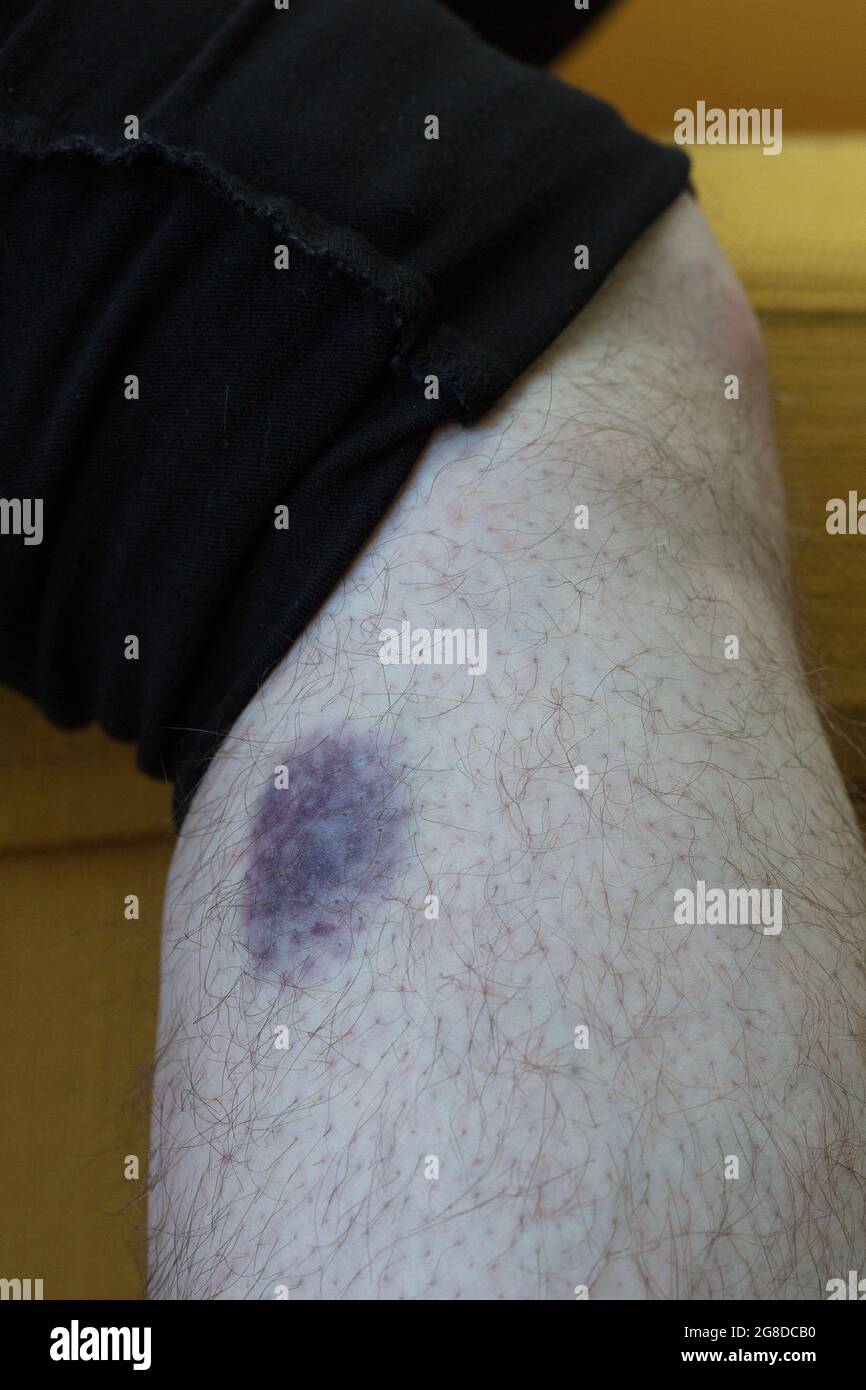 Hematoma pierna fotografías e imágenes de alta resolución - Alamy