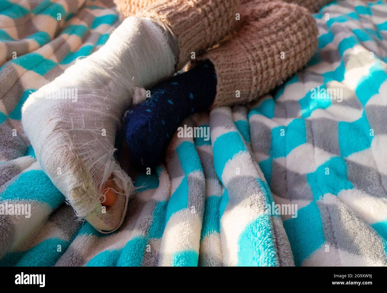 Niño con venda en la fractura del talón de la pierna. Pie derecho roto, hueso, pantorrilla, tobillo, pierna en yeso, férula de niño. Pequeño boi durmiendo en una blanke azul Foto de stock