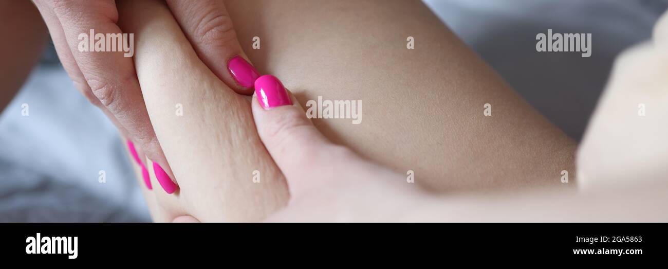 Mano mujer sosteniendo el pliegue gordo con celulitis en el muslo cierre Foto de stock