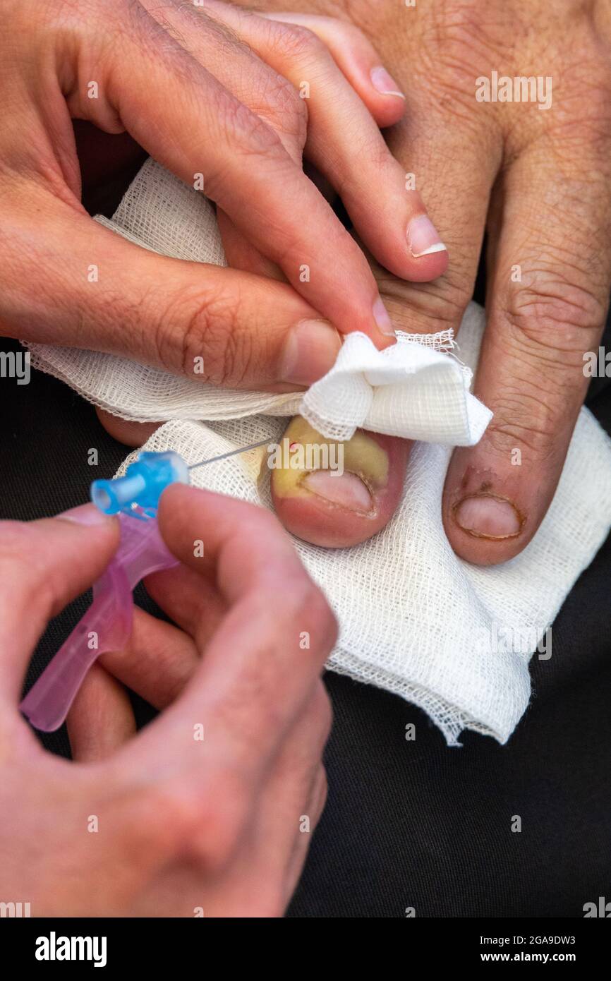médico que practica una punción con aguja en dedo infectado por una uña con pus y bacterias infecciosas de grandes proporciones con enfoque selectivo de stock - Alamy