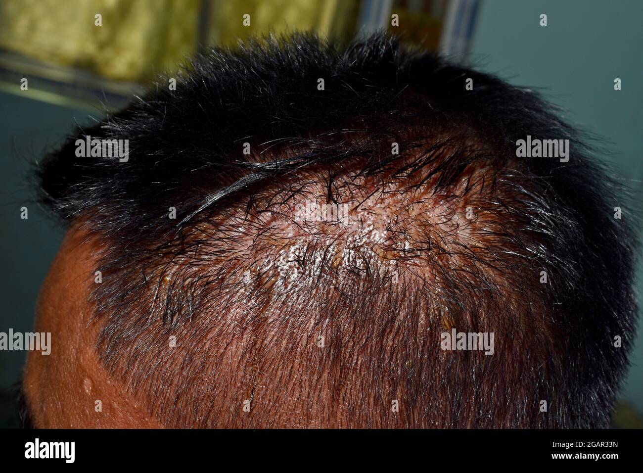 Dermatitis seborreica en el cuero cabelludo del sudeste asiático, paciente  adulto varón de Myanmar. Vista lateral Fotografía de stock - Alamy