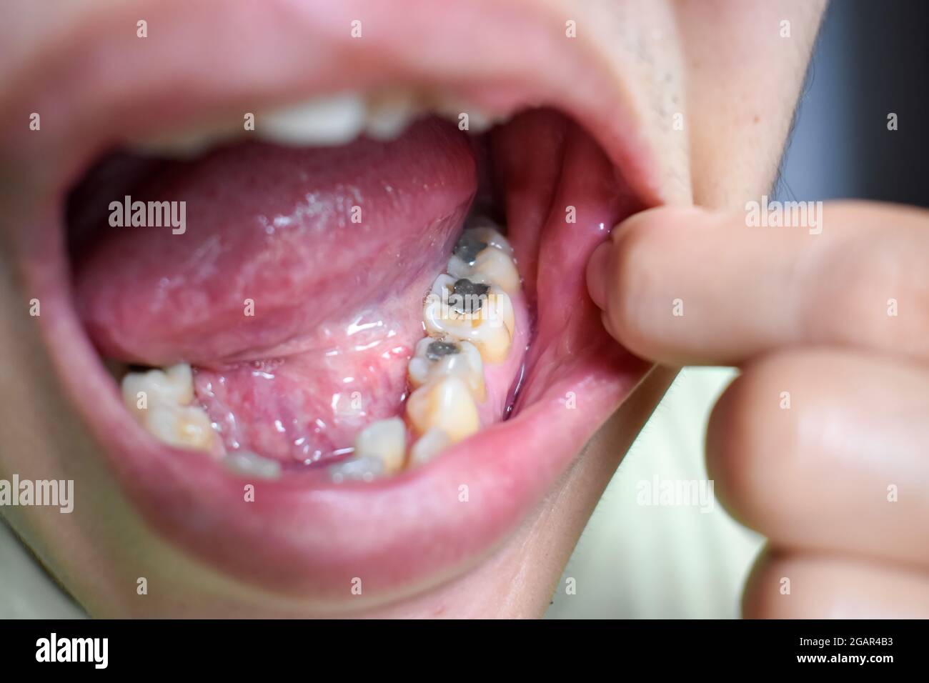 Amalgama dental dañada fotografías e imágenes de alta resolución Alamy