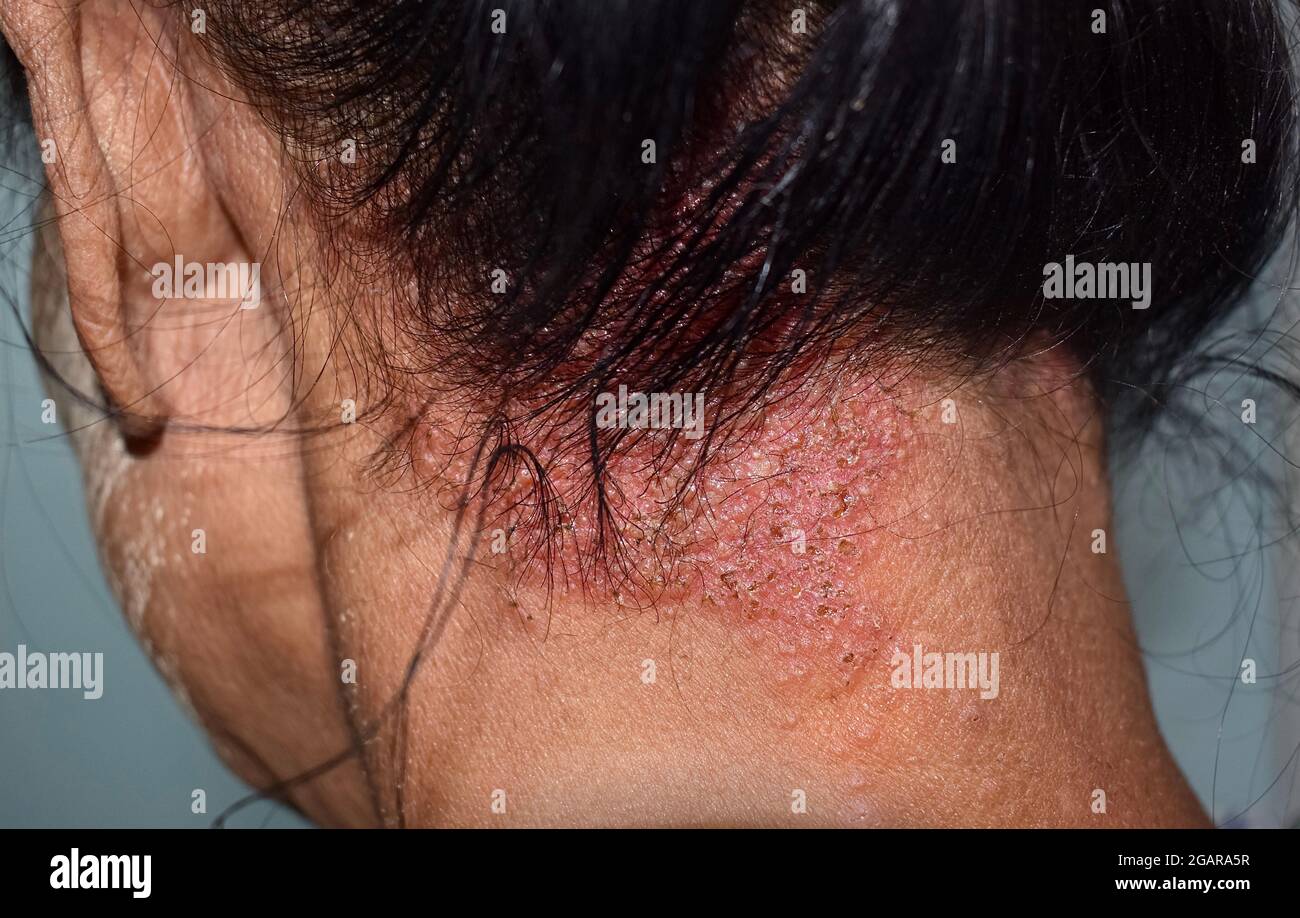 Dermatitis seborreica o infección micótica de la piel en el cuero cabelludo de la paciente adulta del sudeste asiático, Myanmar. Vista lateral izquierda. Foto de stock