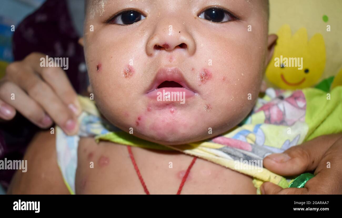 Múltiples impétigo o numerosas infecciones cutáneas por estafilococos/estreptococos en la cara del niño birmano del sudeste asiático en la clínica de Myanmar Foto de stock