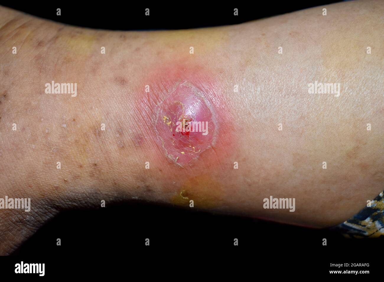 Absceso inminente con celulitis circundante o infección cutánea por estafilococos/estreptococos en la pierna derecha de un paciente asiático birmano. Vista de primer plano. Es Foto de stock