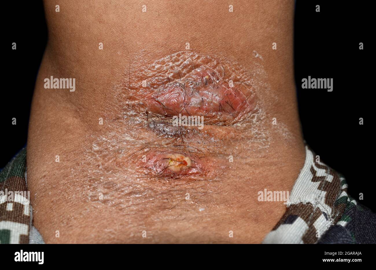 Carbuncle y foliculitis con celulitis circundante o infección cutánea por estafilococos/estreptococos en axila de paciente asiático birmano. Aislado o Foto de stock