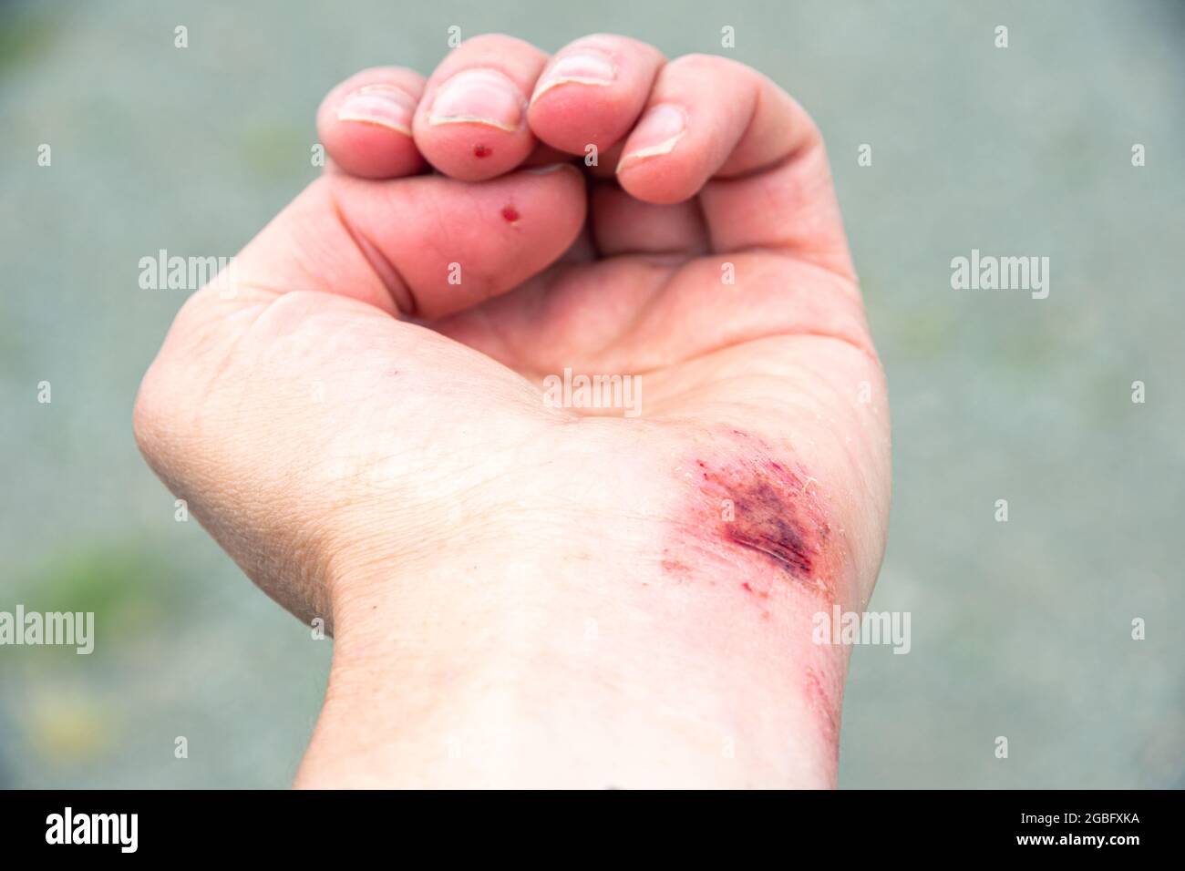 Herida roja en la palma, la mano, la muñeca después de una quemadura o  caída, primer plano. Primeros auxilios en el tratamiento de heridas.  Tratamiento de heridas Fotografía de stock - Alamy