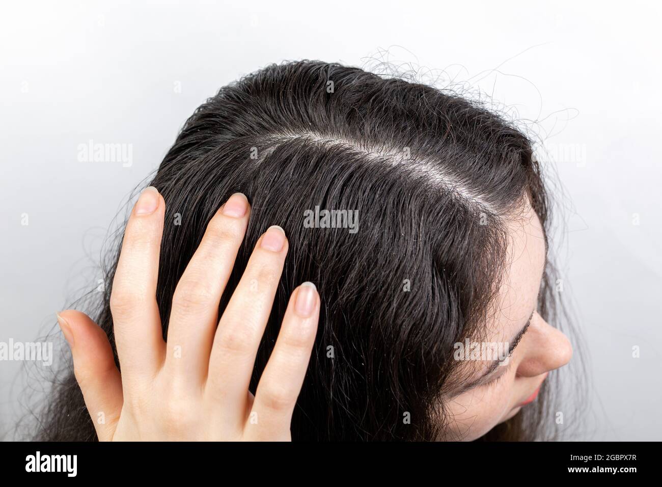 Problemas de caspa y cabello. La mujer rasca su cuero cabelludo con sus  manos, mostrando cabello oscuro con caspa. Fondo blanco. Vista superior  Fotografía de stock - Alamy