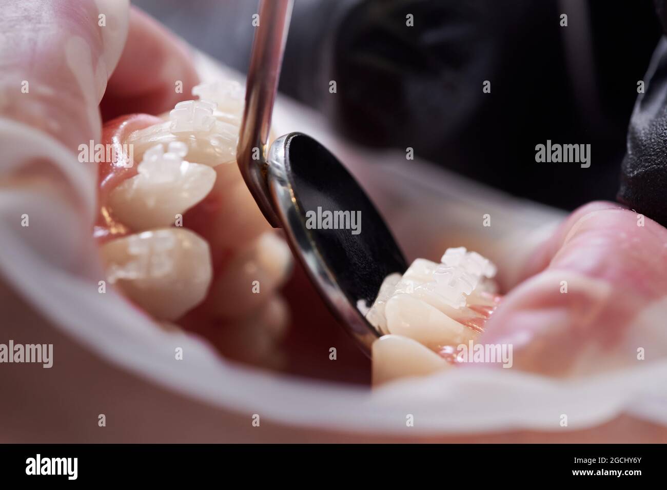 Primer plano del ortodoncista que revisa los dientes y los aparatos ortopédicos del paciente con un espejo dental. Persona con retractor de mejilla en la boca y soportes en los dientes que se realiza un procedimiento dental en la clínica. Concepto de odontología Foto de stock