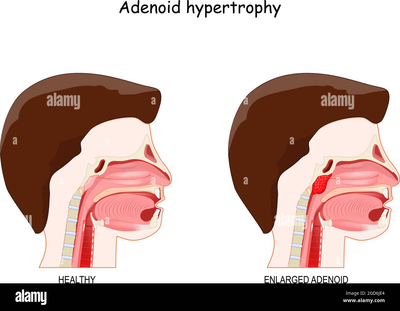 adenoidectomia imágenes recortadas de stock alamy