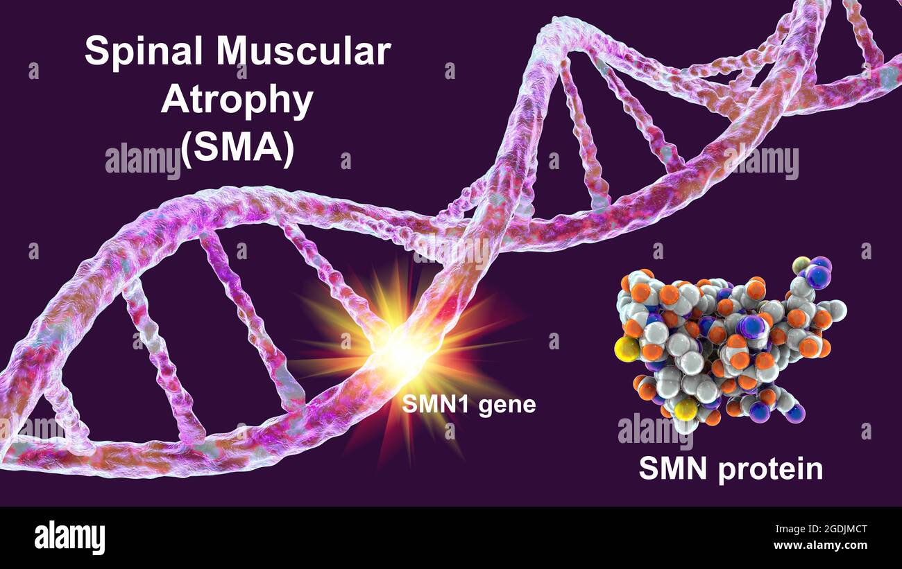 Atrofia muscular espinal, ilustración Fotografía de stock Alamy
